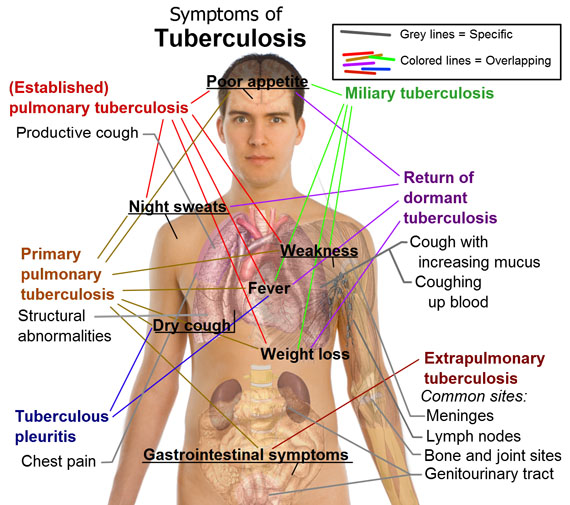 The early symptoms of tuberculosis include coughing, night sweats, fever, weakness and chest pain. Heavy cigarette smokers who cough frequently may not notice the symptoms right away. (ILLUSTRATION HARVESTED FROM WIKEPEDIA)