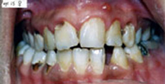 This photo from 2006 shows the teeth of a teenager who did not receive good dental advice or care. (FILE PHOTO)